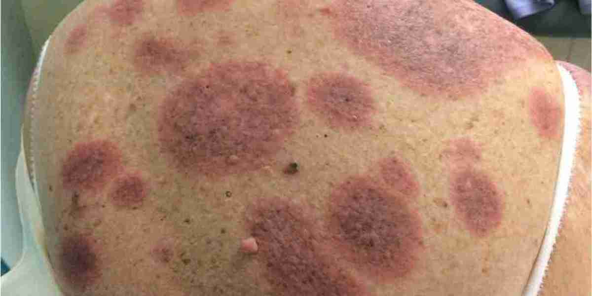 Granuloma Annulare Cancer Risk: The Hidden Link You Must Not Ignore