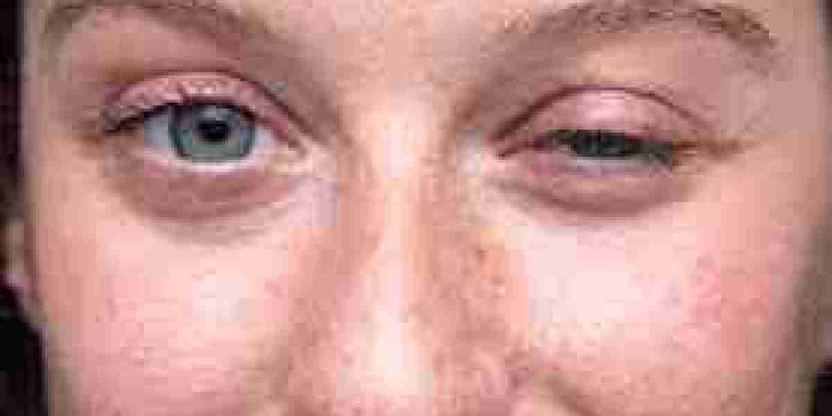 Myasthenia Gravis Diagnostics and Treatment Market Research (2025–2034)