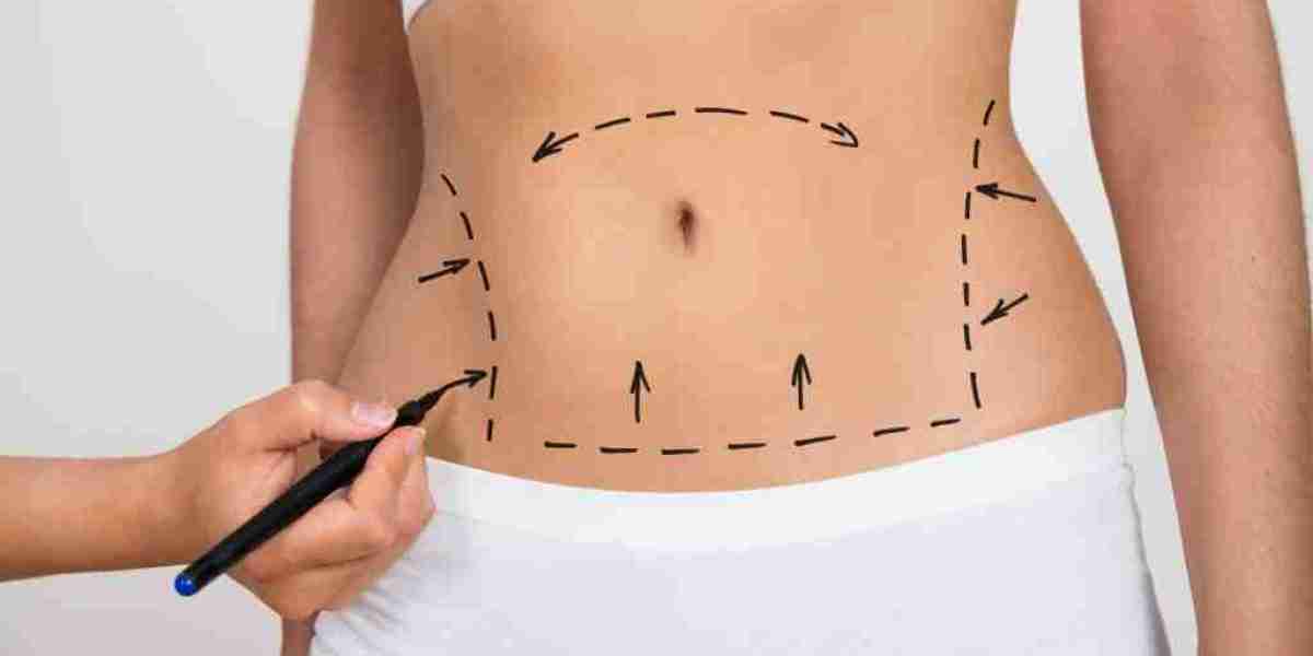 Liposuction for Moms in Islamabad – Restore Pre-Pregnancy Shape