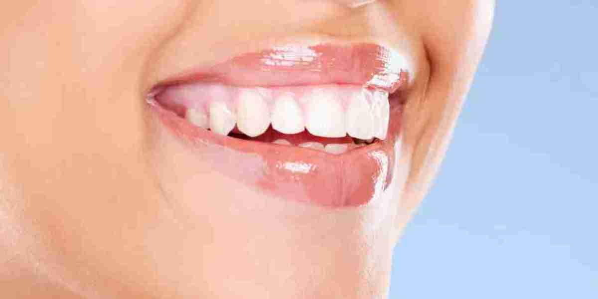 Street Style Bright Smile Boost Using Teeth Whitening Power