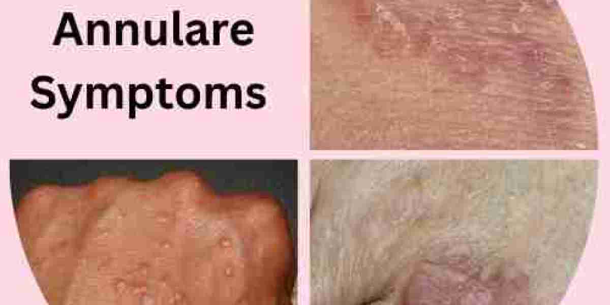 How to Spot Granuloma Annulare Symptoms Early: A Clear Patient Guide