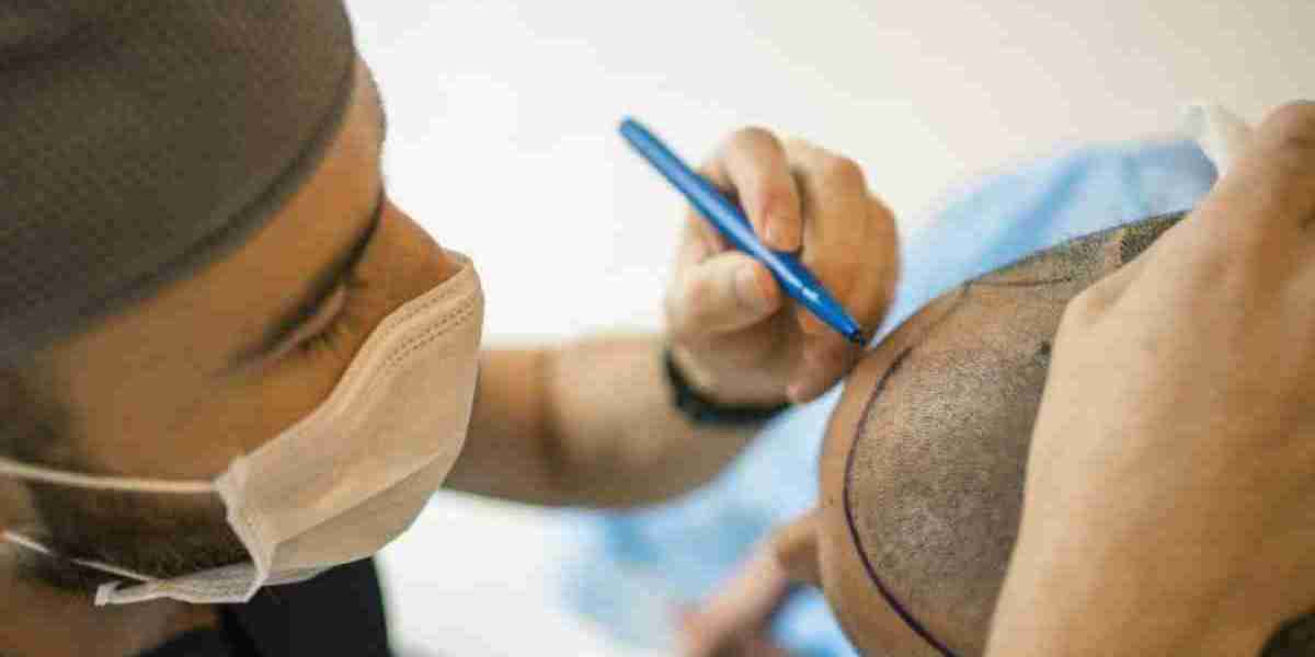 Hair Transplant in Islamabad Excellence in Hair Restoration
