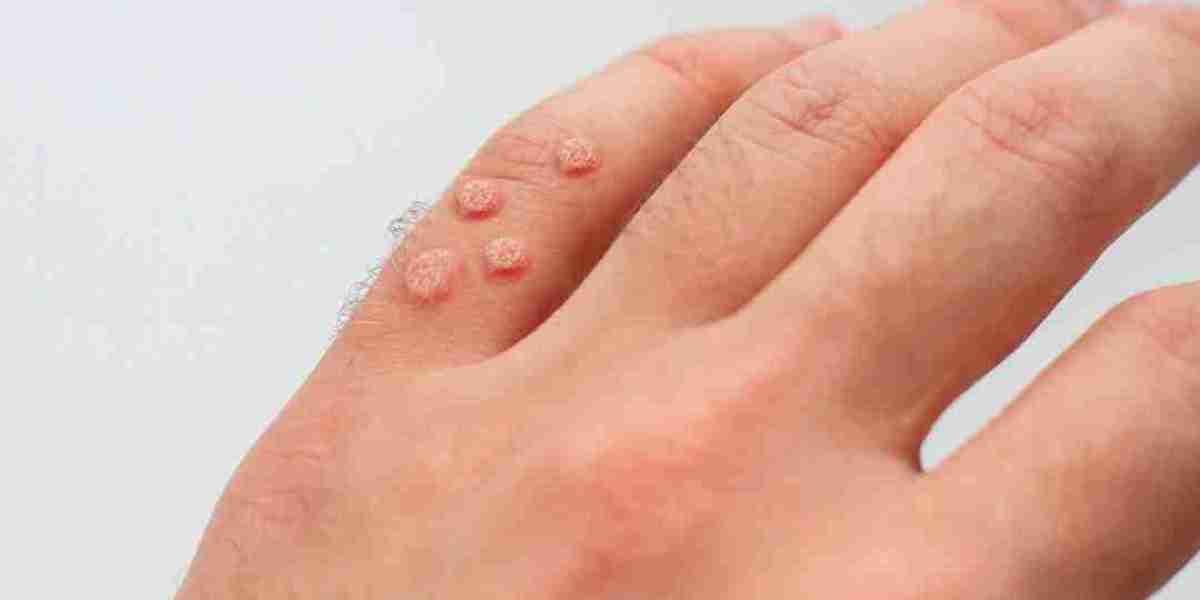 Social Media’s Favorite Wart Removal Tips