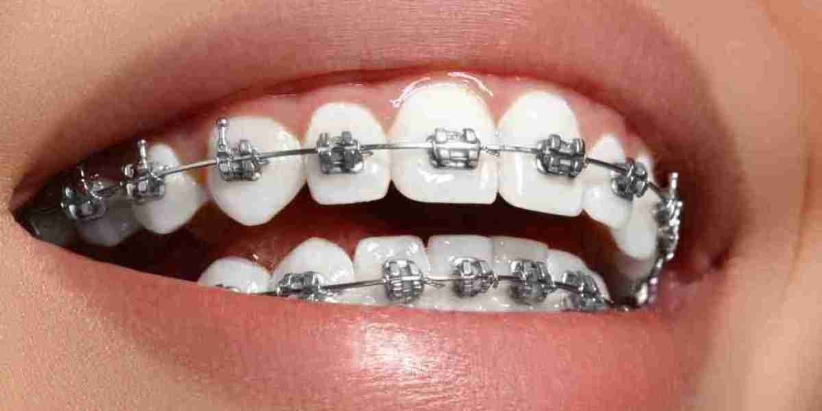 Feel bold smile confidence rise Dental Braces transformation