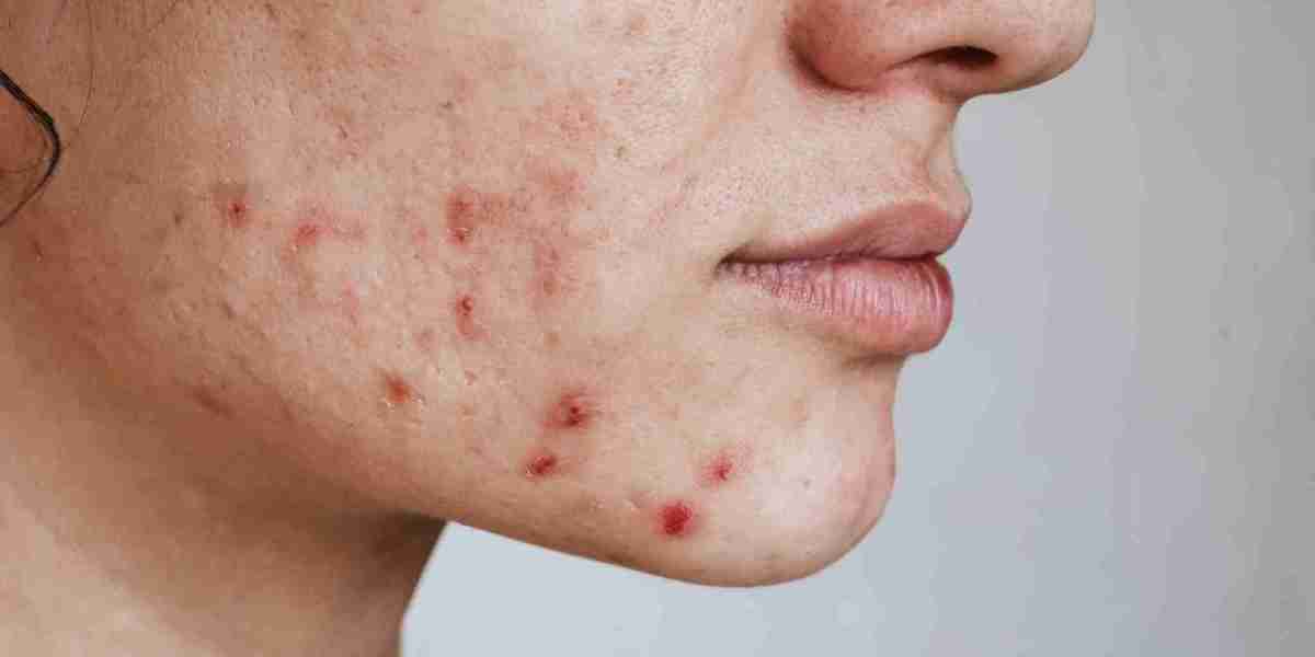 Confidence Boost Through Acne Treatment in Dubai
