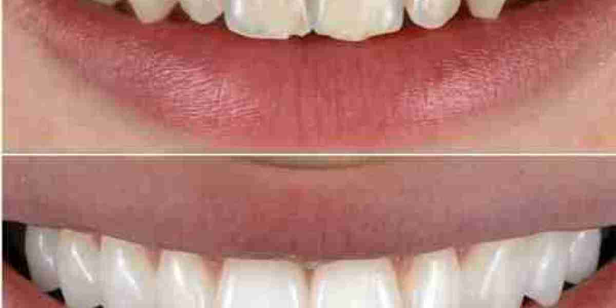 Non-Prep Veneers Luxury Bright Smile Flow for Iconic Shine Look