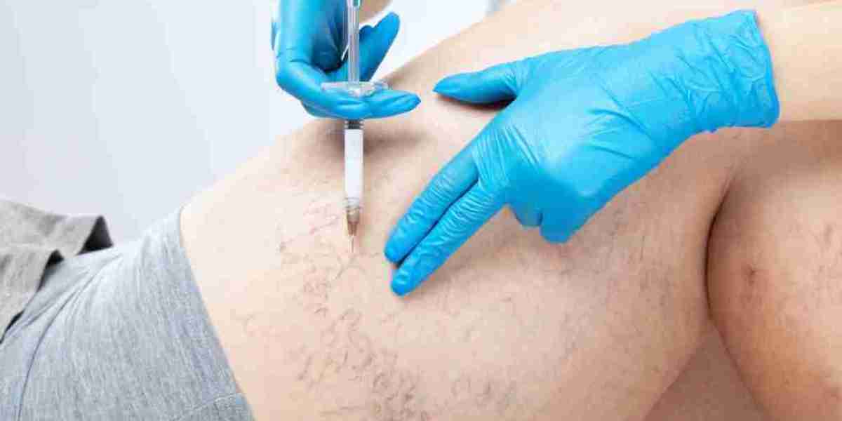 Spider Veins Treatment: How It Works on Different Areas