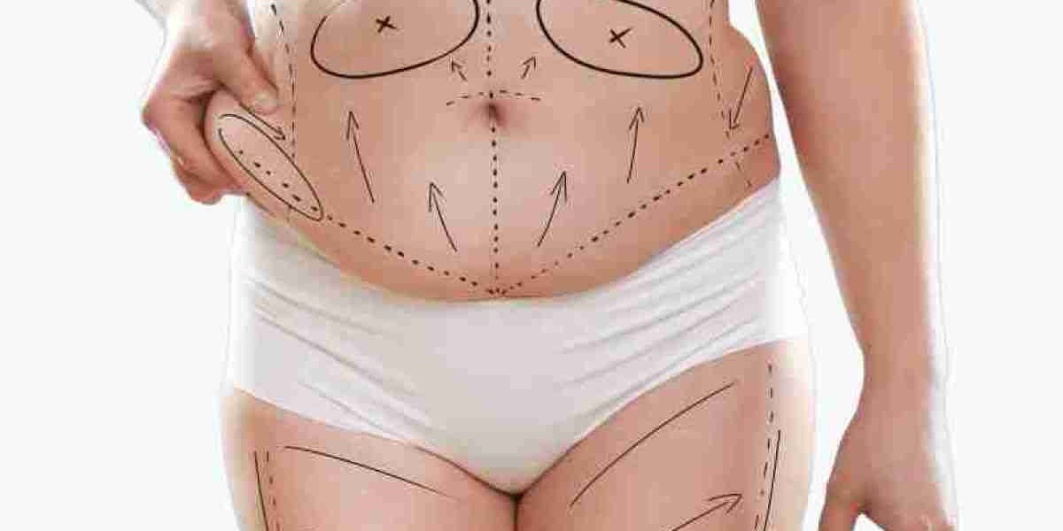 Tummy Tuck and Stretch Mark Removal Explained