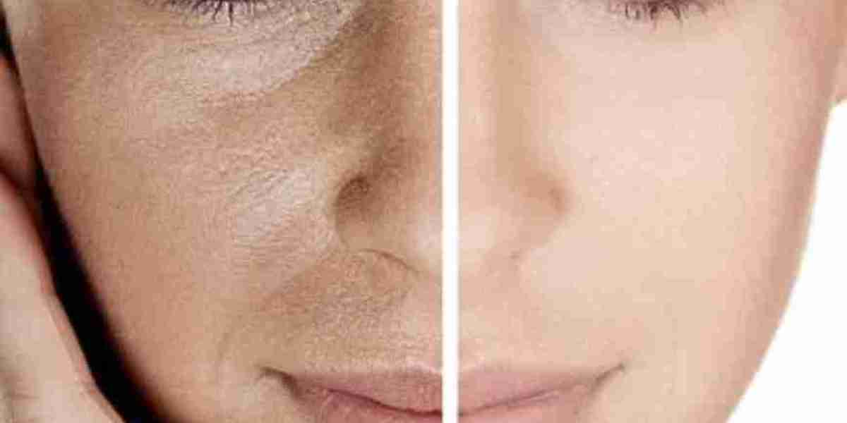 Pigmentation Removal Treatment & Stretch Marks Treatment: Complete Guide to Advanced Skin Solutions