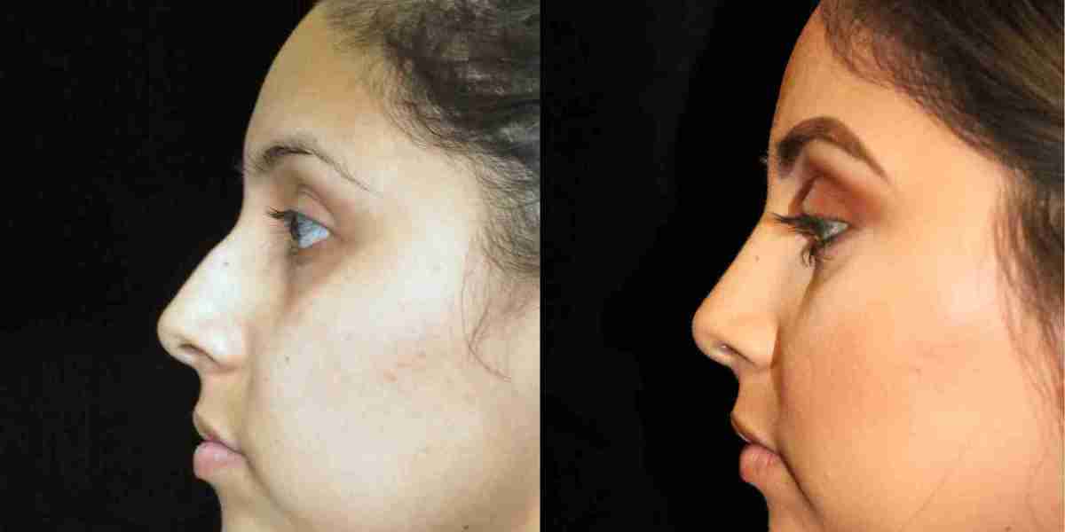 تجميل الأنف في دبي بتقنية الموجات فوق الصوتية (البيزو)
