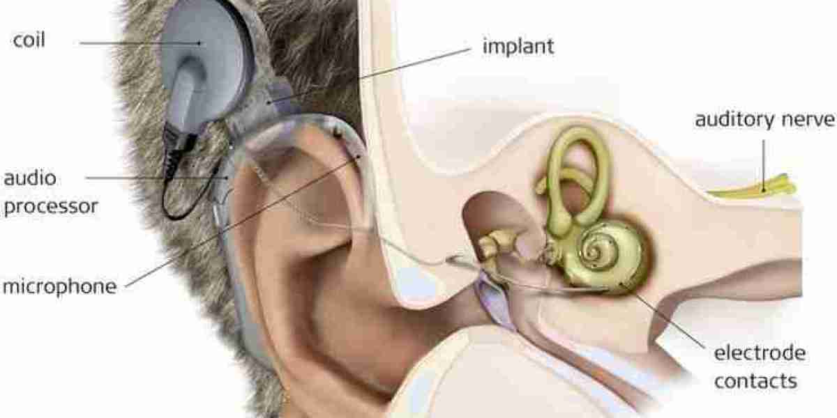 Latin America Cochlear Implants Market Demand & Growth Forecast