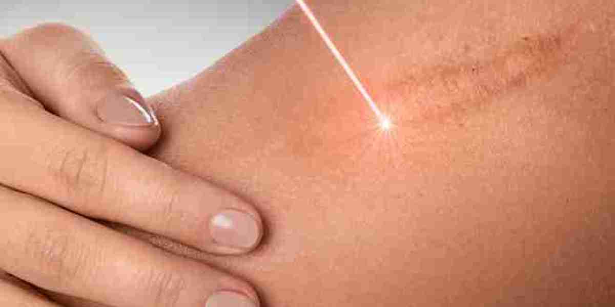 Elite Skin Strategy Keloid Treatment in Dubai radiant skin reset mode