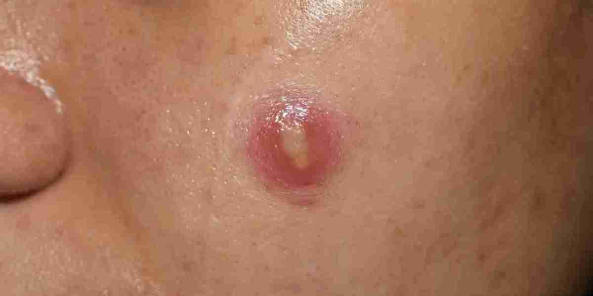 Fast Relief Energy Incision and Drainage of Abscesses Healing Surge Flow
