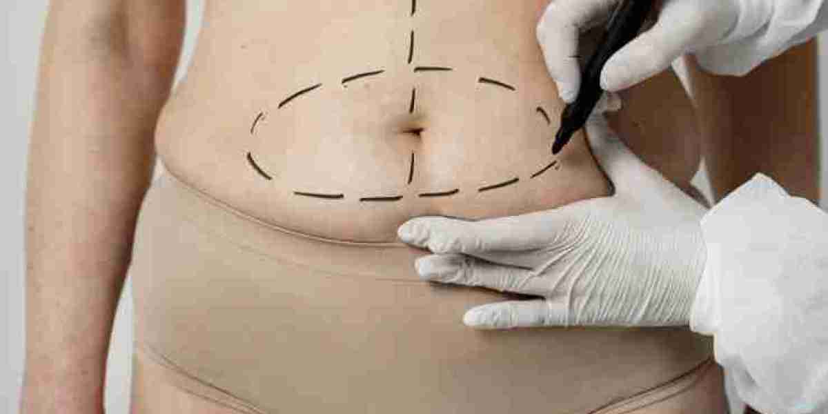 Common Misconceptions About Liposuction Surgery