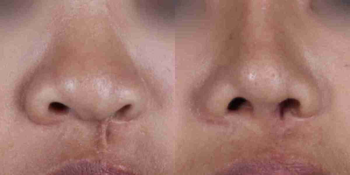 Rhinoplasty in Islamabad: A Beginner's Guide to the Entire Treatment Process