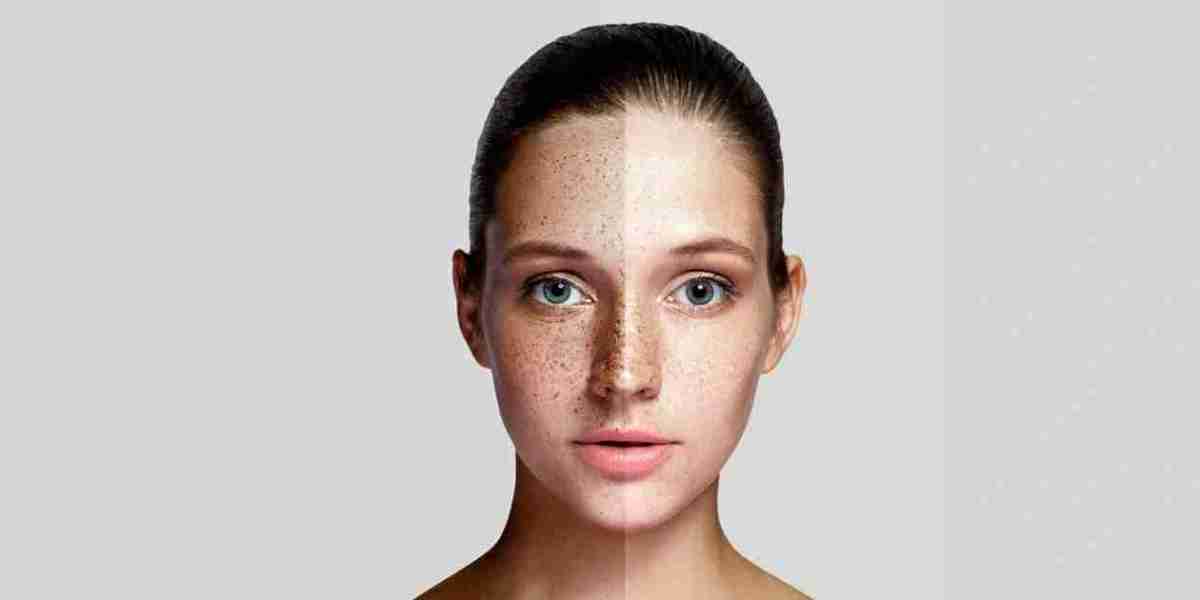 Is Personalized Melasma Treatment More Effective?