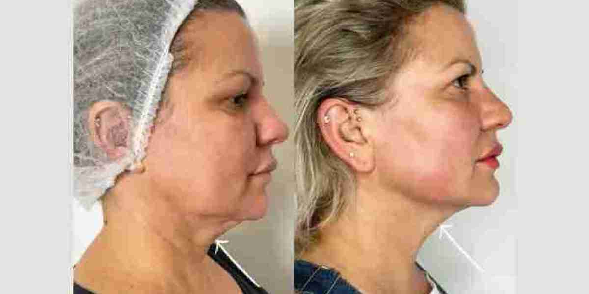 Best Plastic Surgeon in dubai Providing Endolift Skin Tightening Solutions