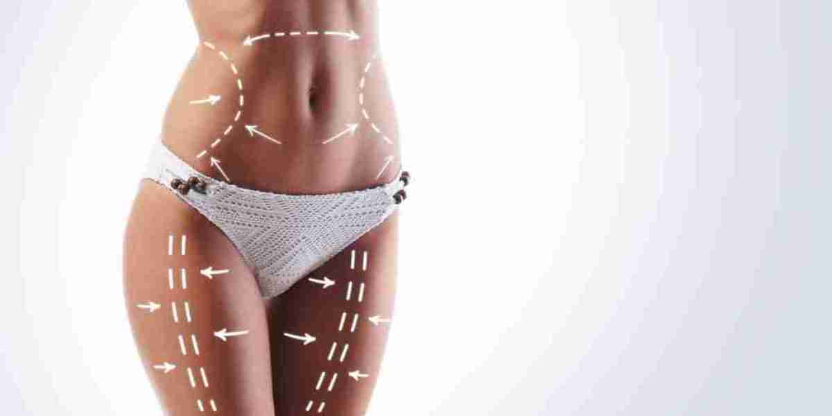 Liposuction Surgery in Islamabad: A Complete Guide to the Recovery Process
