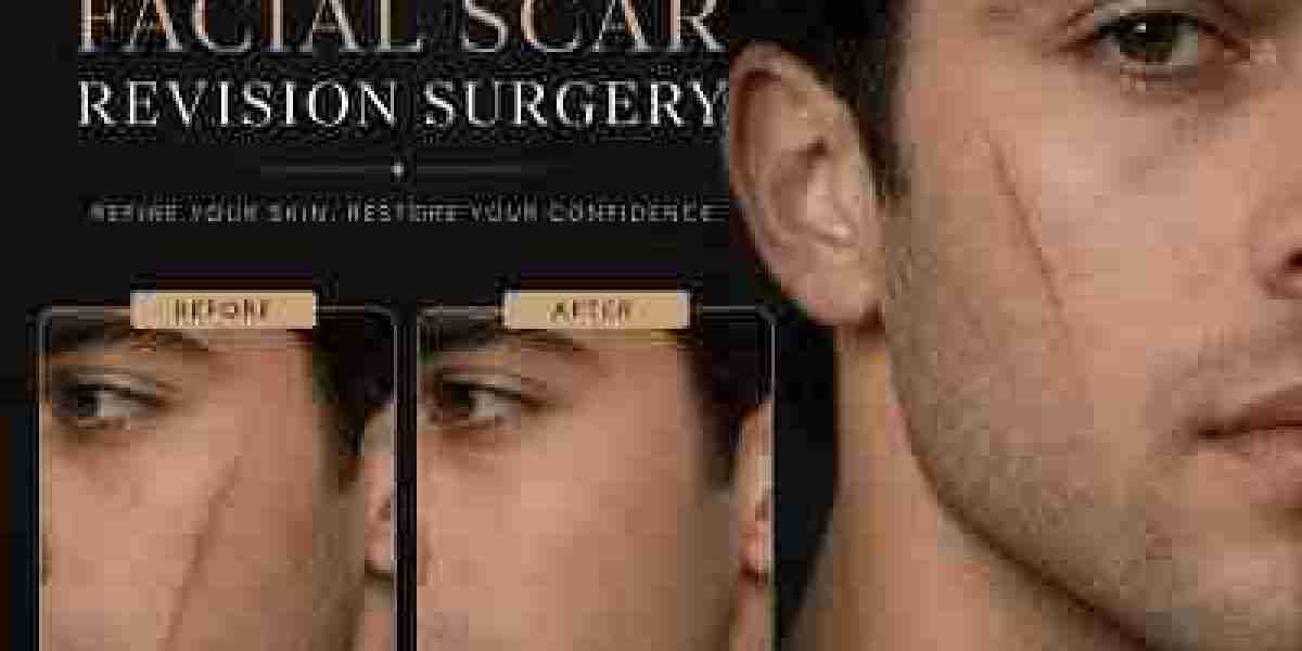 Facial Scar Revision for Old and New Scars