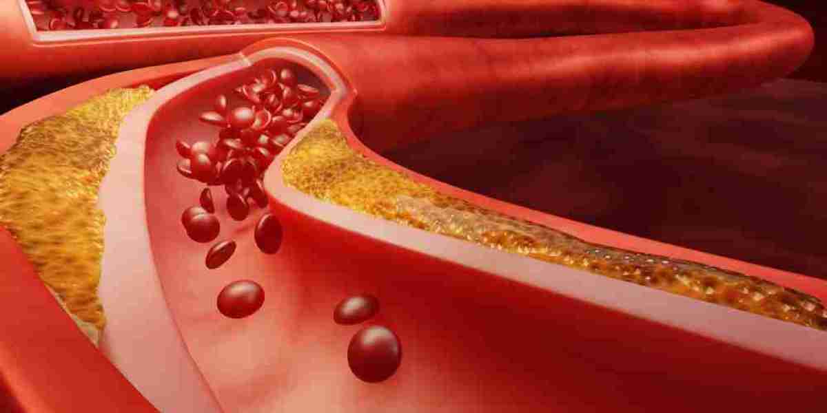 What Is ASCVD? How Lifestyle Changes Can Help Prevention