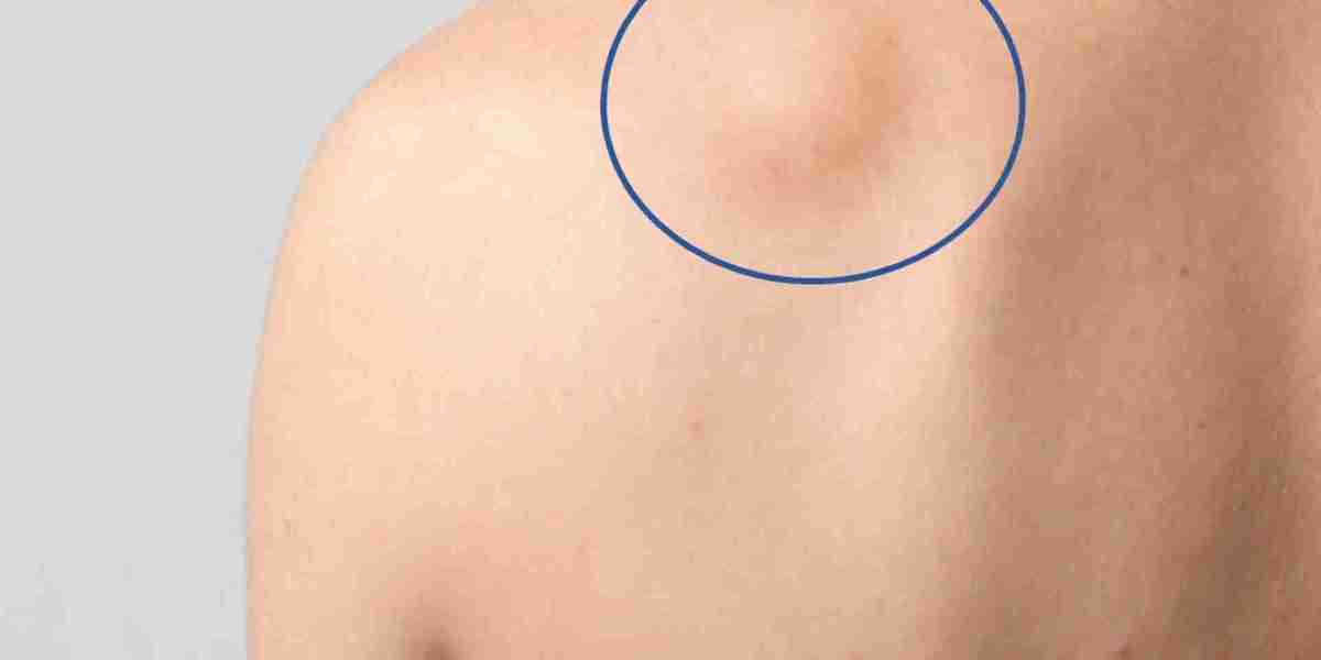 Can Targeted Lipoma Treatment Enhance Soft Tissue Smoothness Result?