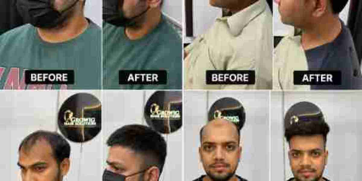 Hair Patch Service Centre in Dwarka: A Modern Solution for Hair Loss