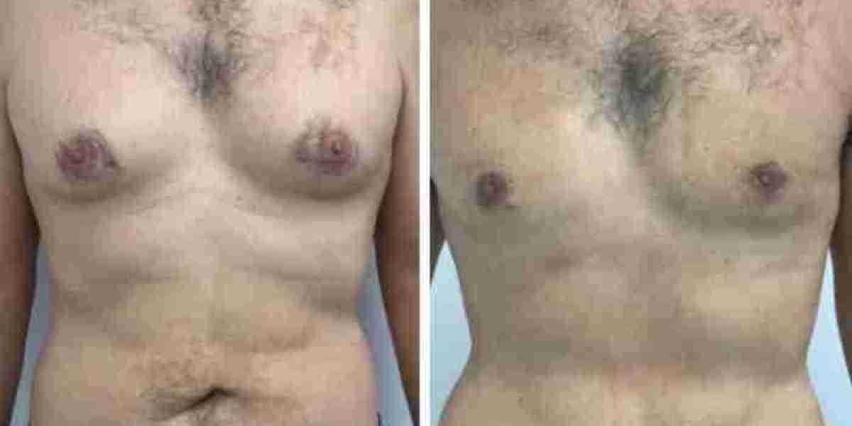 How Best Gynecomastia Surgeons in Dubai Create Customized Recovery Plans