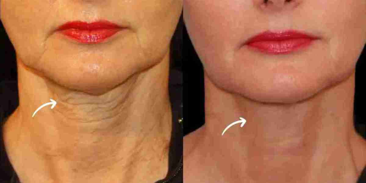Best Plastic Surgeon in Dubai Sculptra for Mature Beauty