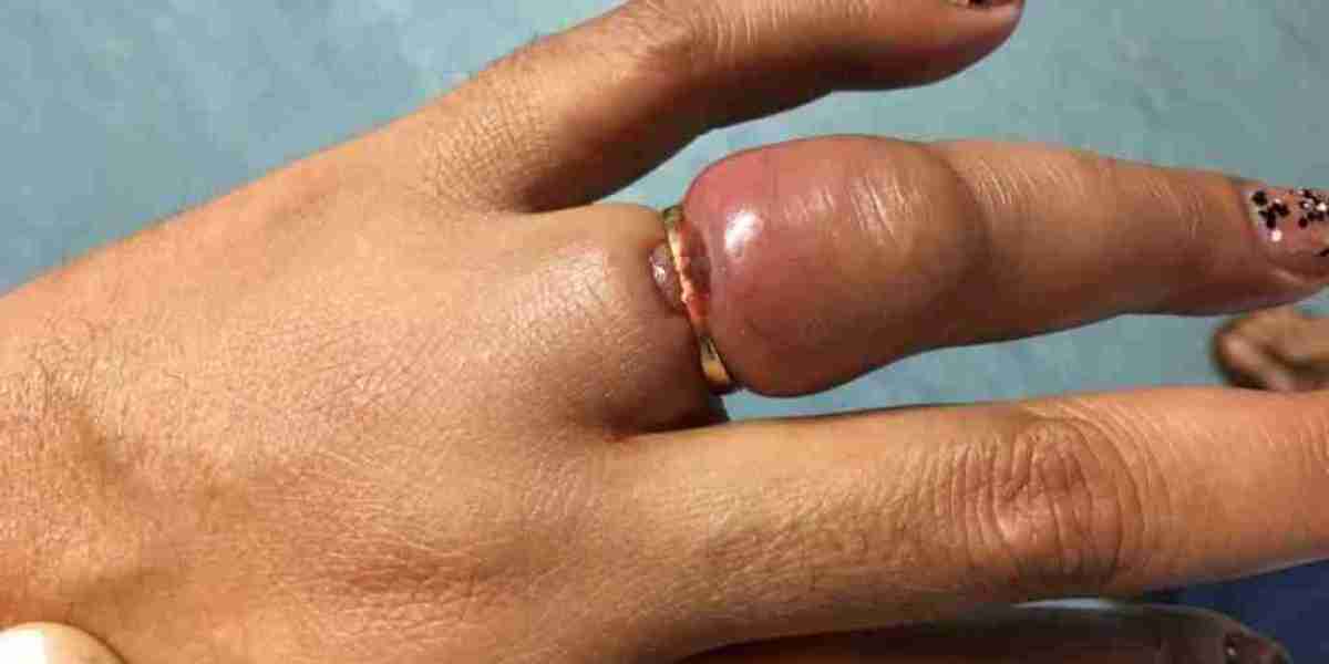 How Do You Get Rings Off A Swollen Finger: Safe and Easy Methods