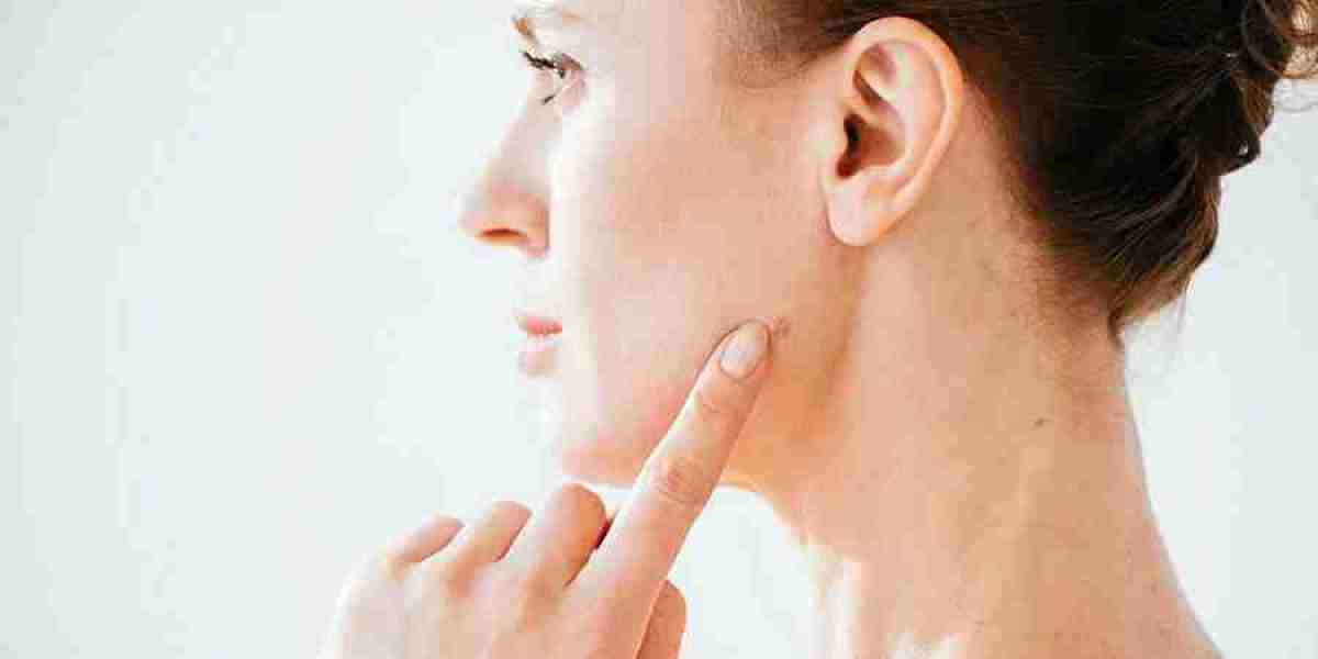 How Can I Remove A Beauty Mark?