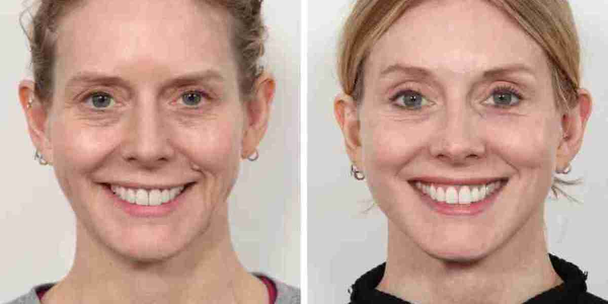 Thread Lift Treatment in Dubai for Smooth, Firm Skin