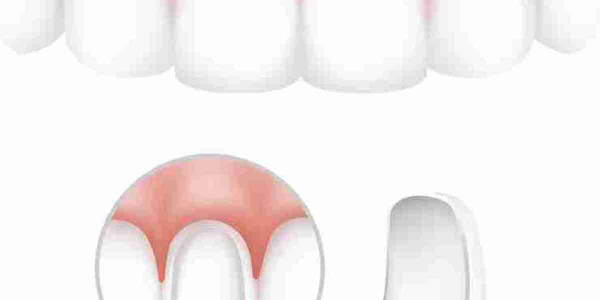 Dental Veneers Dubai: Understanding the Treatment Process