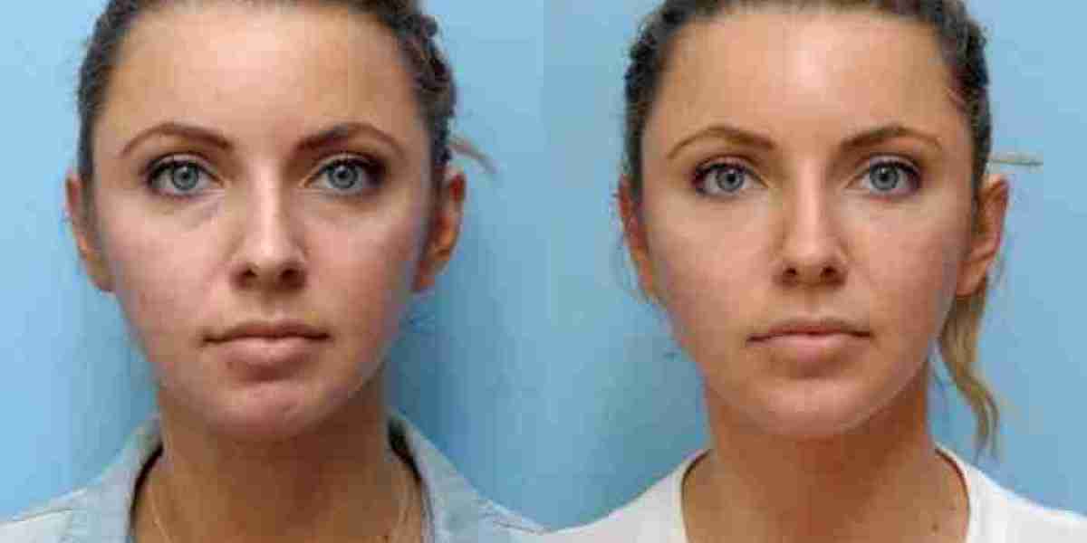 Thread Lift Treatments in Dubai: Facial Harmony with Precision Lifting