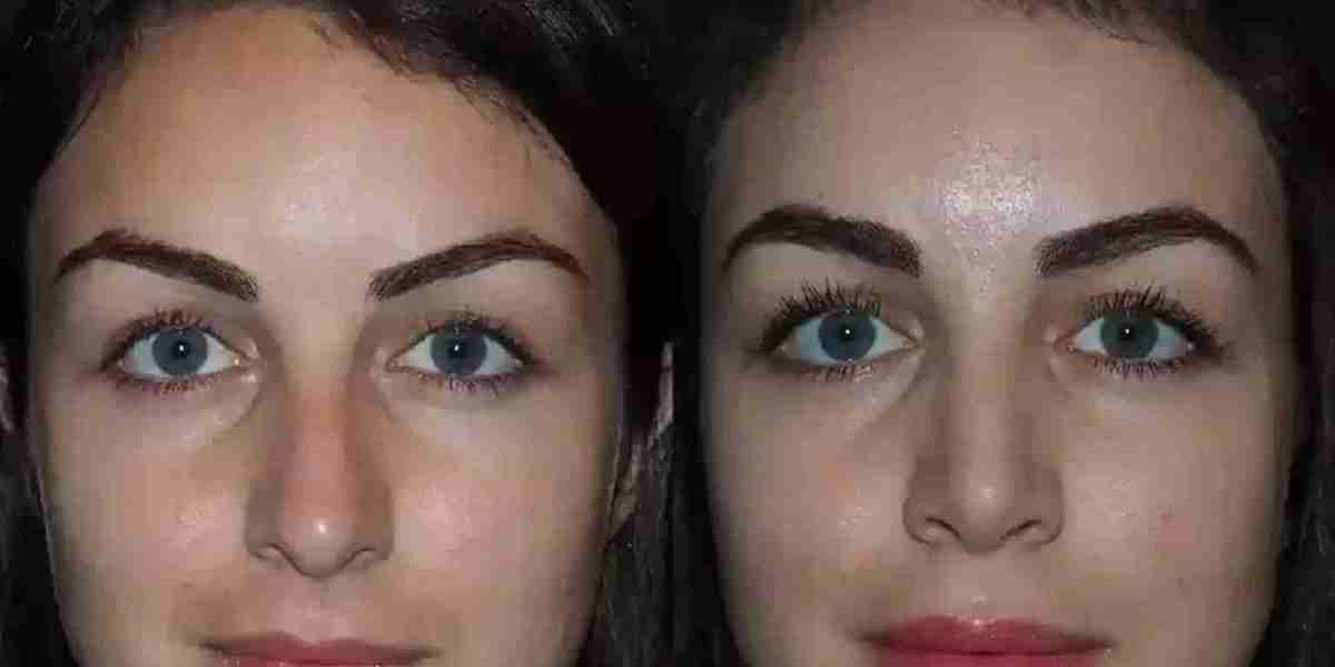 Can Children Benefit from Nose Deviated Septum Surgery in Dubai?