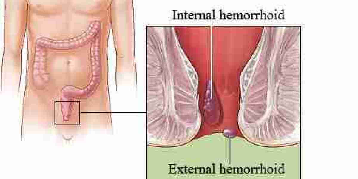 Why Early Haemorrhoids Treatment in Dubai Matters | Symptoms, Benefits & Recovery