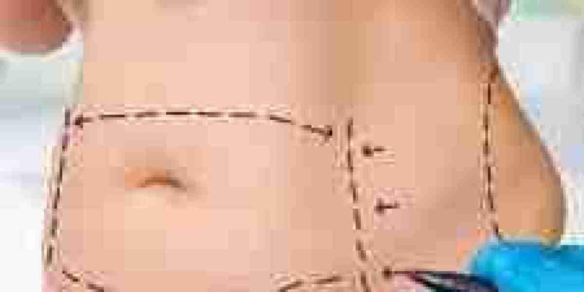 Modern Techniques Used in Liposuction Surgery in Dubai for Effective Body Contouring