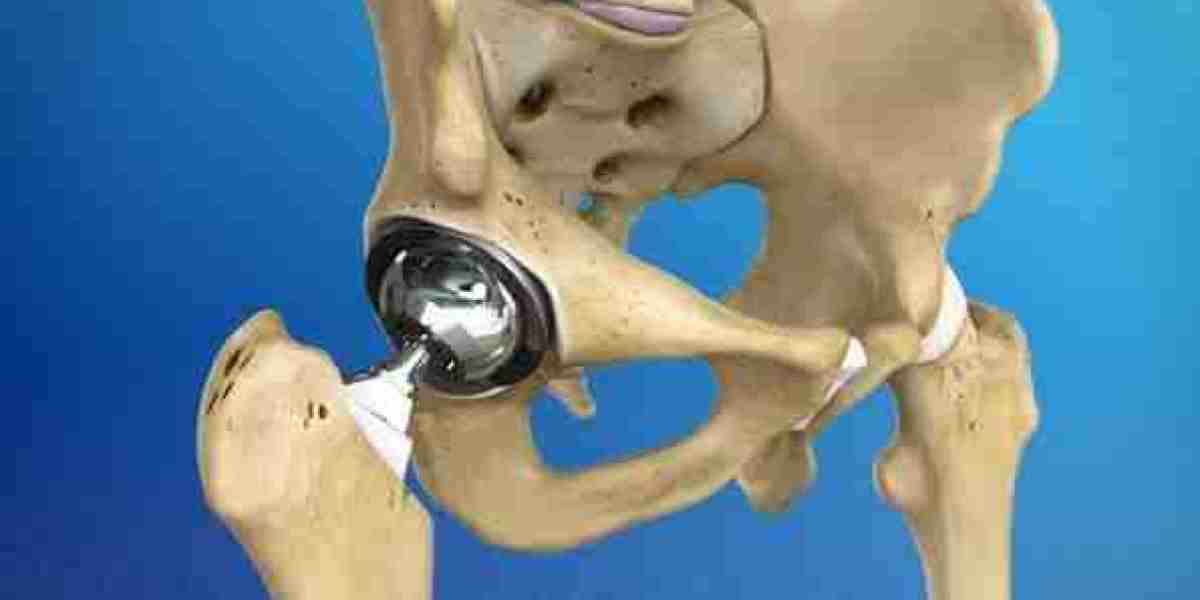 Hip Replacement and Improved Daily Activities