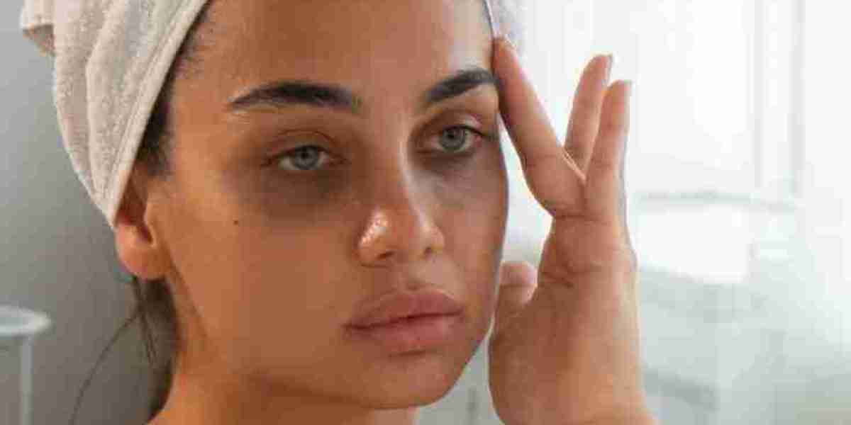 Dark Circles Treatment in Islamabad: Your Guide to Clearer, Brighter, and More Youthful Eyes