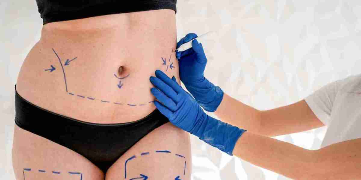 Laser Liposuction Dubai for Confident Living