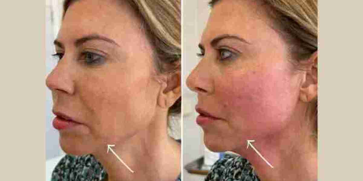 Best Plastic Surgeons in dubai Using Advanced Endolift Technology