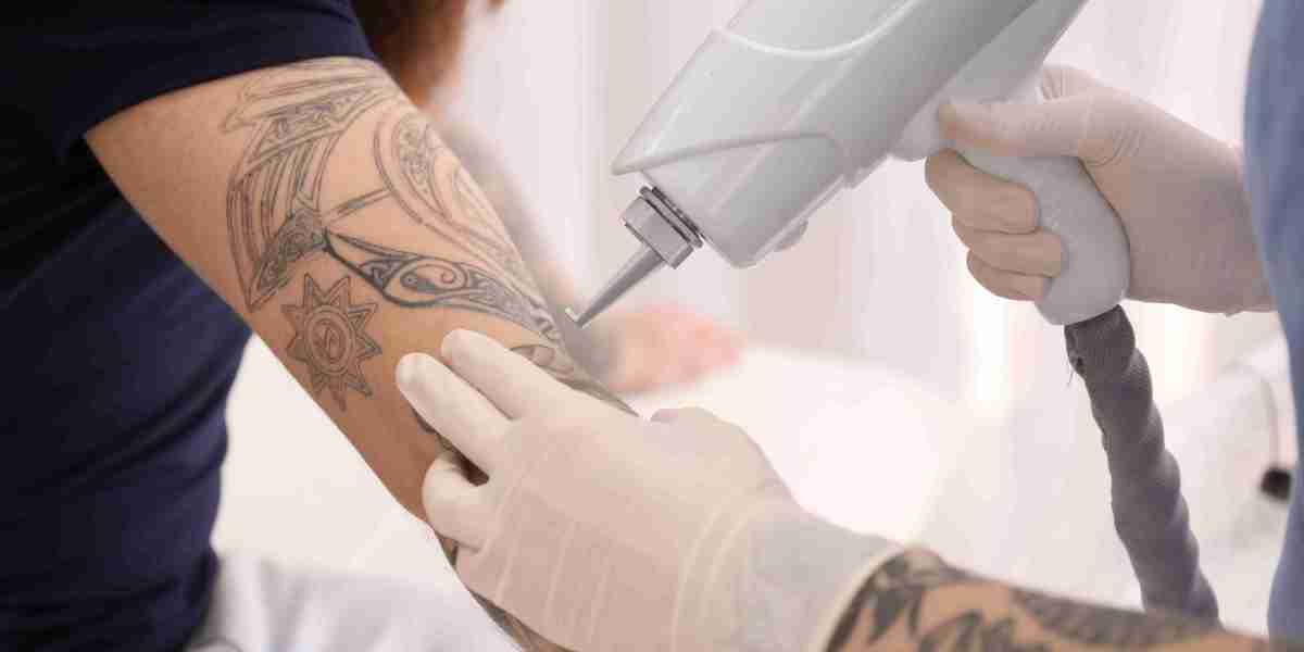 Tattoo Removal in Islamabad: The Best Way to Refresh Your Appearance