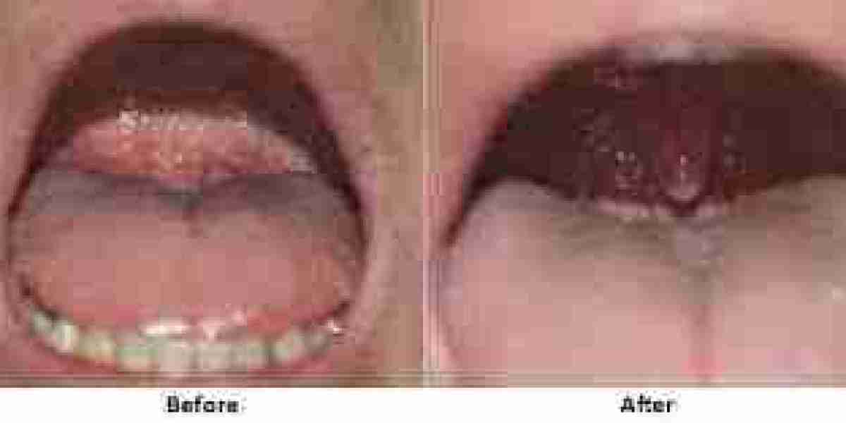 Wake Up Refreshed with Snoring Treatment in Dubai | Better Sleep Solutions