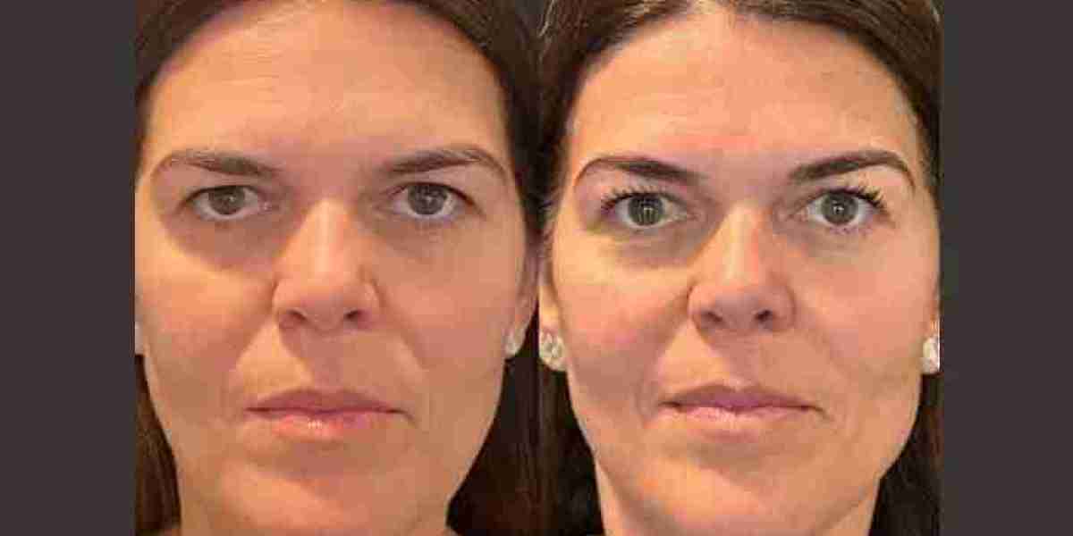 Thread Lift Treatments in Dubai: Skin Tightening With Minimal Discomfort