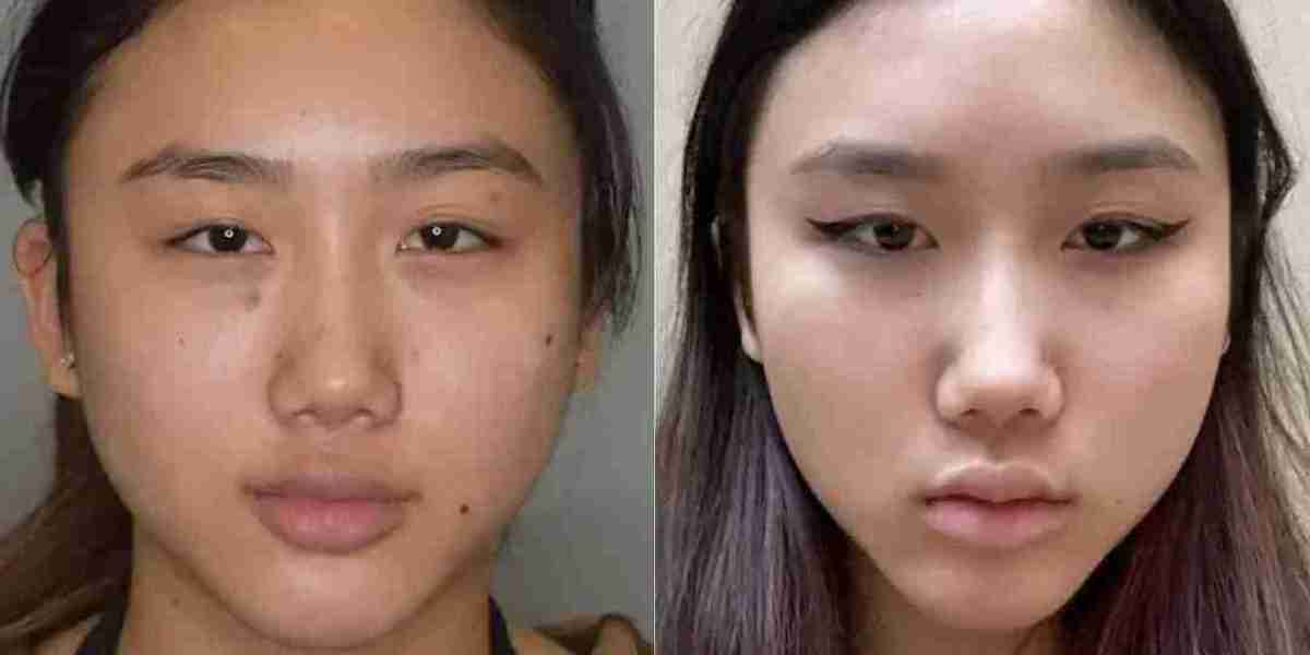 Best Buccal fat removal Surgeon in dubai Treatment Guide