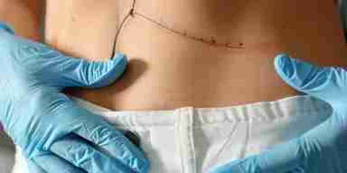 Tummy Tuck in Dubai: Defining Your Waistline for Good