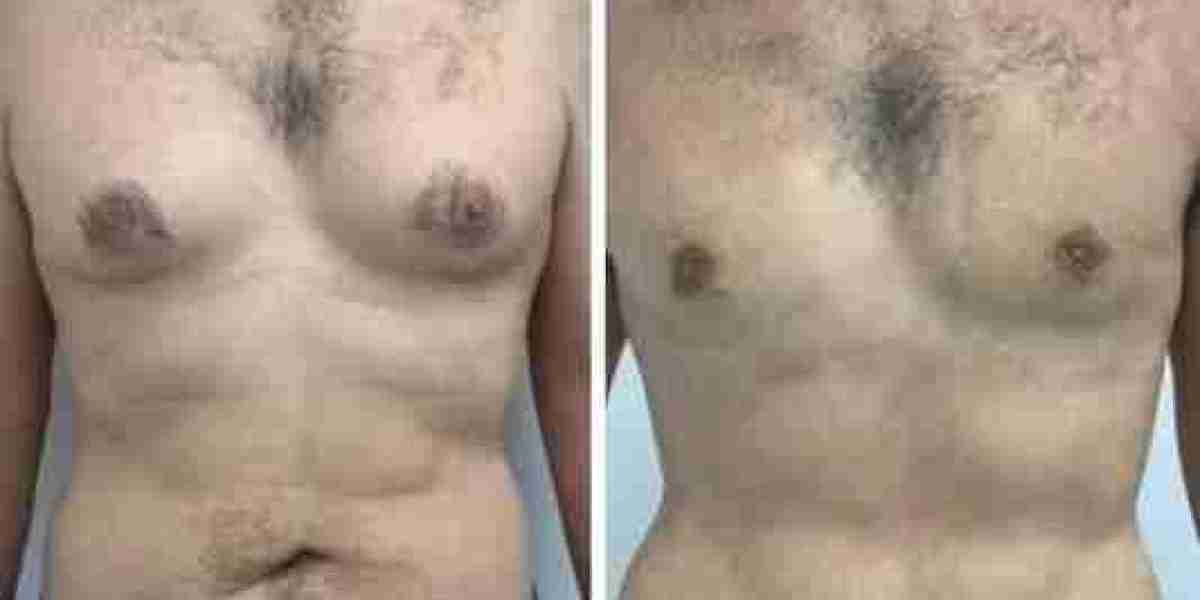 Best Doctors in Dubai for Gynecomastia: Understanding Surgical Safety Measures