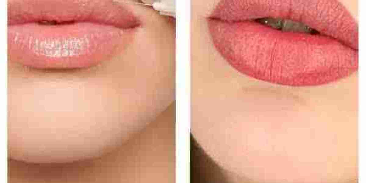 Russian Lip Fillers in Dubai for Balanced Facial Features | Complete Guide