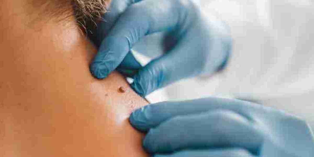 Birthmark Removal in Islamabad: Tips for Healthy Skin Before and After Treatment