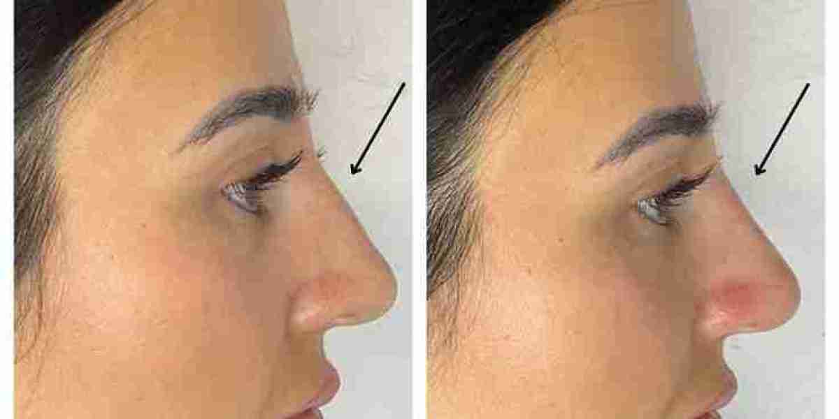Why Choose Liquid Rhinoplasty in Dubai for Nose Shape
