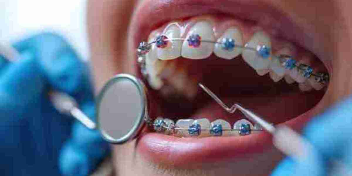 Braces Cost in Pakistan: How Braces Can Improve Your Smile and Oral Health